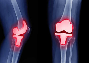 x-ray image of total knee arthroplasty / total knee replacement side view and front view show...