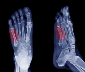 x-ray image of bone fracture at 5th Metatarsal left foot - obrazy, fototapety, plakaty