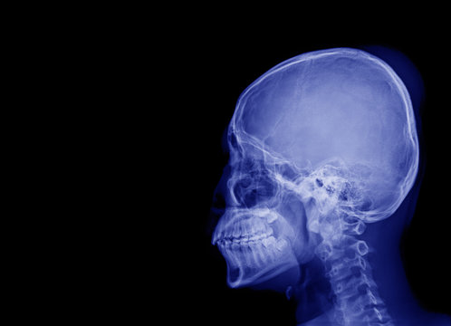 X-ray image of side view asian skull and blank area at left side