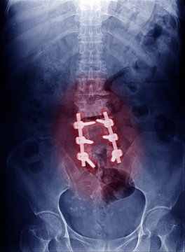 Xray image of patient's lumbar spine who have chronic back pain, spinal stenosis or lumbar spine compression on nerve root and fix by Orthopedic surgeon