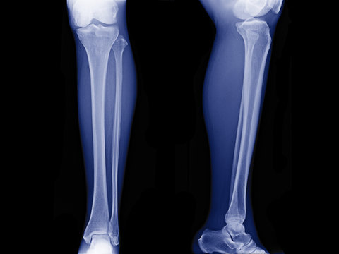 x-ray image of leg front view and side view , xray of normal leg bone in adult