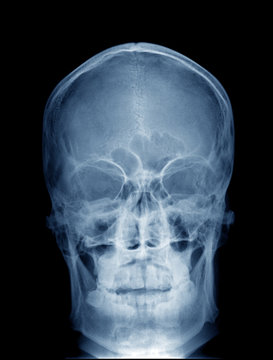 photo of front view x-ray picture of human skull in blue colors