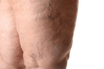 Woman's legs with varicose on white background, closeup