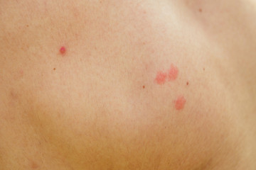Fototapeta premium acne on the skin close-up