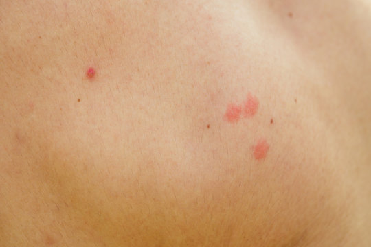 acne on the skin close-up