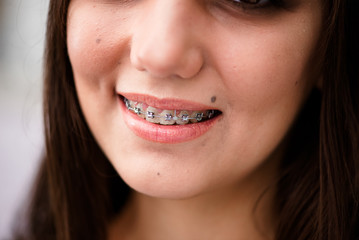 Beautiful Smiling Girl showing Retainer, Braces for Teeth. Orthodontics Dental Theme, Methods of Teeth Bite Correction, Close-up