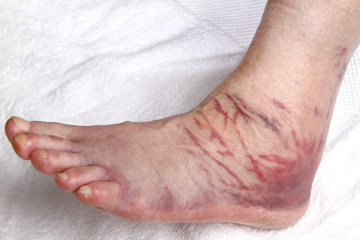 ligament rupture on ankle joint