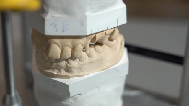 Articulator on Dental Mould