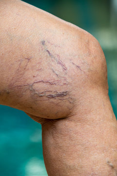 Varicose veins on knees and  legs in Senior women