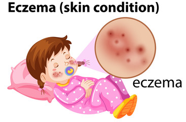 Magnfied eczema on young girl