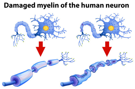 Dammaged Myelin of the Human Neuron