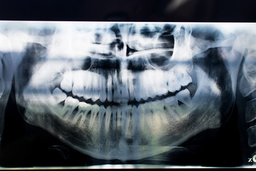 X-ray of a mouth with all visible teeth and cavity in evidence. Orthopanoramic radiographt at the...