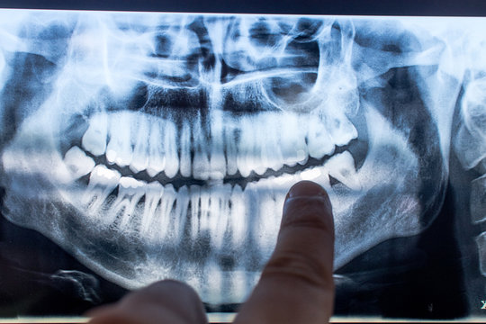 X-ray of a mouth with all visible teeth and cavity in evidence. Orthopanoramic radiographt at the dentist with caries and fillings showned by the doctor. teeth image.