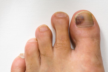 The bruised finger of the male foot close-up.