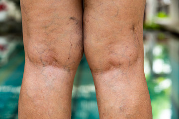 Fototapeta na wymiar Varicose veins on the back of knees and legs in Senior women