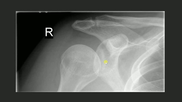 First person view of doctor examening X-ray film of right shoulder
