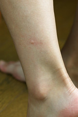 蚊に刺された足