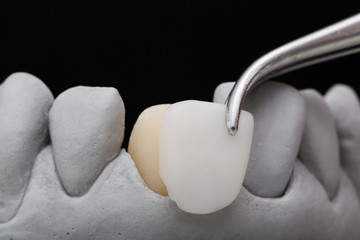 Close up shot of measuring the crown of a tooth with tweezers.