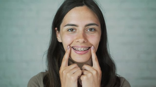 Braces on the teeth. The girl smiles showing her braces on her teeth. White and healthy teeth