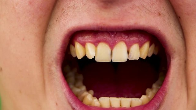 Macro video of yellow teeth. A close-up of a tooth, struck by caries. The concept of poor oral care. Rot, unpleasant odor, carious teeth. Close-up of the mouth