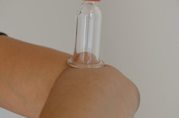 Close up on cupping bulb attached to person