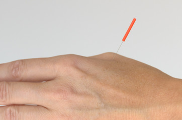 Close up of hand with acupuncture needle attached