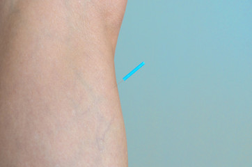 Close up of skin with acupuncture needle attached
