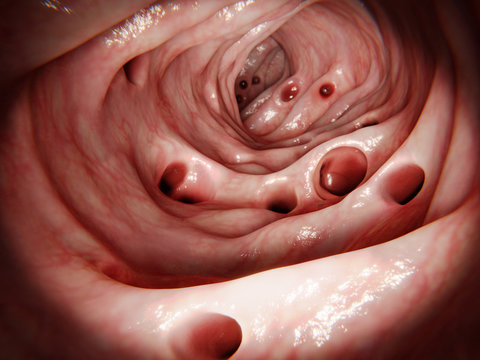 Massive diverticulosis in human intestine