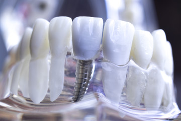 Dentist dental teeth implant