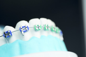 Dental metal brace teeth model