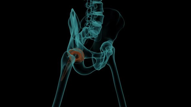 Human skeleton with a metal hip prosthesis concept arthroplasty 3d render animation X-ray image