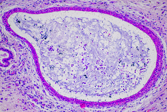 micrograph of human nasal polyp