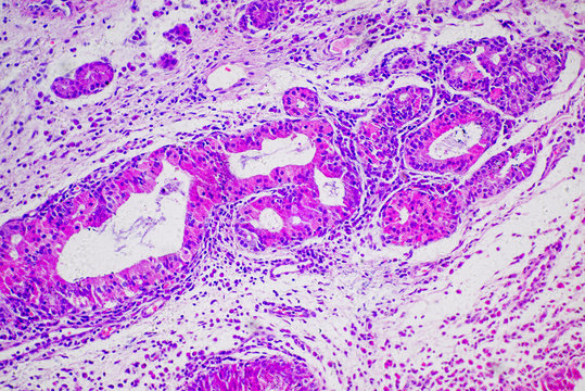 micrograph of human nasal polyp