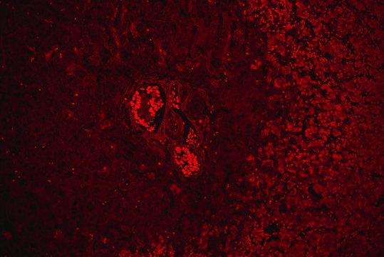 chronic obstruction of human liver