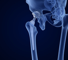 Hip replacement implant installed in the pelvis bone. X-ray view. Medically accurate 3D illustration