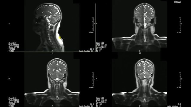 Real MRI Scan of Doctor examining brain and thoracic spine