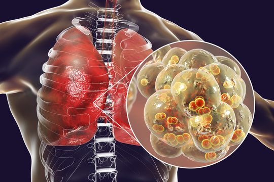Pneumococcal pneumonia, medical concept. 3D illustration showing bacteria Streptococcus pneumoniae inside alveoli of the lung