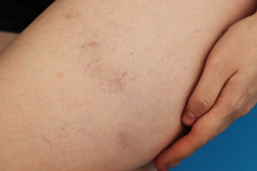 Varicose veins and capillary veins in the legs. Medical inspection and treatment