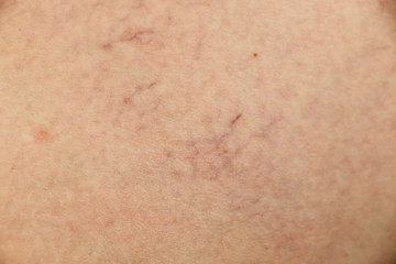 Varicose veins and capillary veins in the legs. Medical inspection and treatment