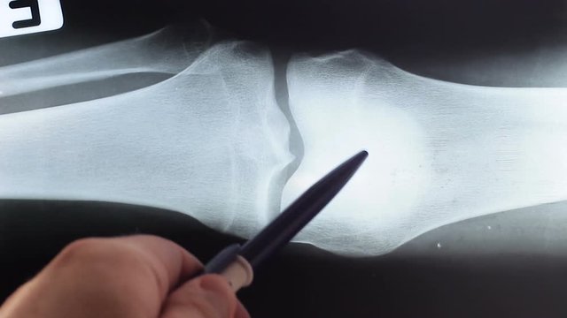 MRI of the patient's knee with a meniscus injury