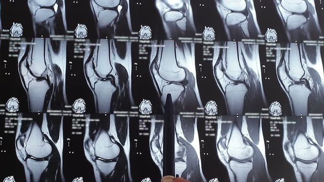 Tomography of the patient with a diseased knee joint, close-up