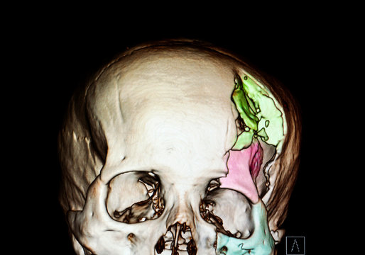 A 3d rendered  CT image of a skull of a patient with severe depression skull fractures with all fractured bones colored differenlty to show the extent of facial bones injuries.