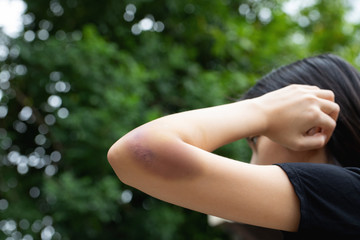 A teenager girl show a big purple bruise on her left arm that is caused by her accidentally fall...