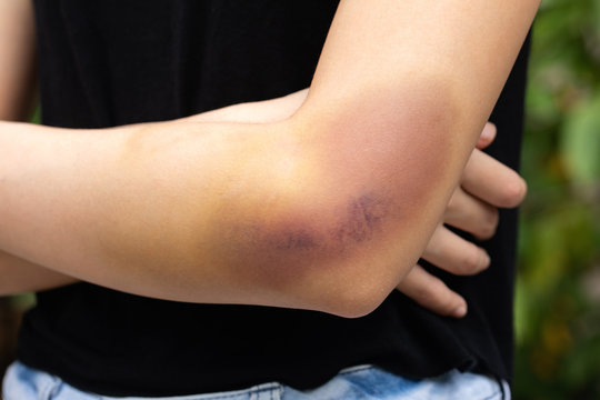 A teenager girl show a big purple bruise on her left arm that is caused by her accidentally fall off from the stairs.