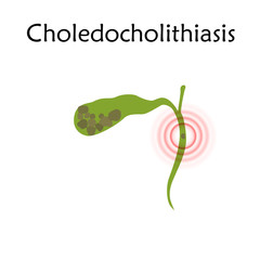 Gallbladder disease, inflammation, gallstone blocks common bile duct. Choledocholithiasis. Anatomy vector flat illustration. White background.