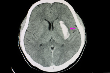CT brain scan with intracerebral hemorrhage