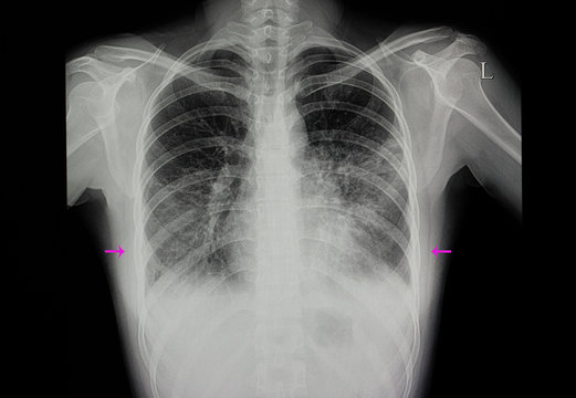 a patient with both lungs pneumonia