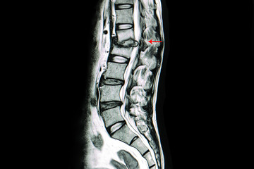 MRI scan of lumbar spines of a patient with kyphosis and back pain showing herniated disc from...