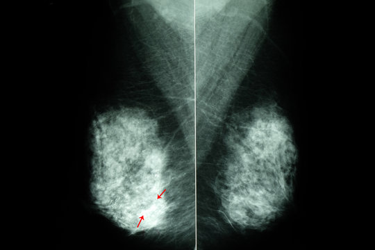 mammogram of  female breasts