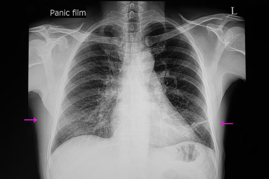 right lower lung pneumonia